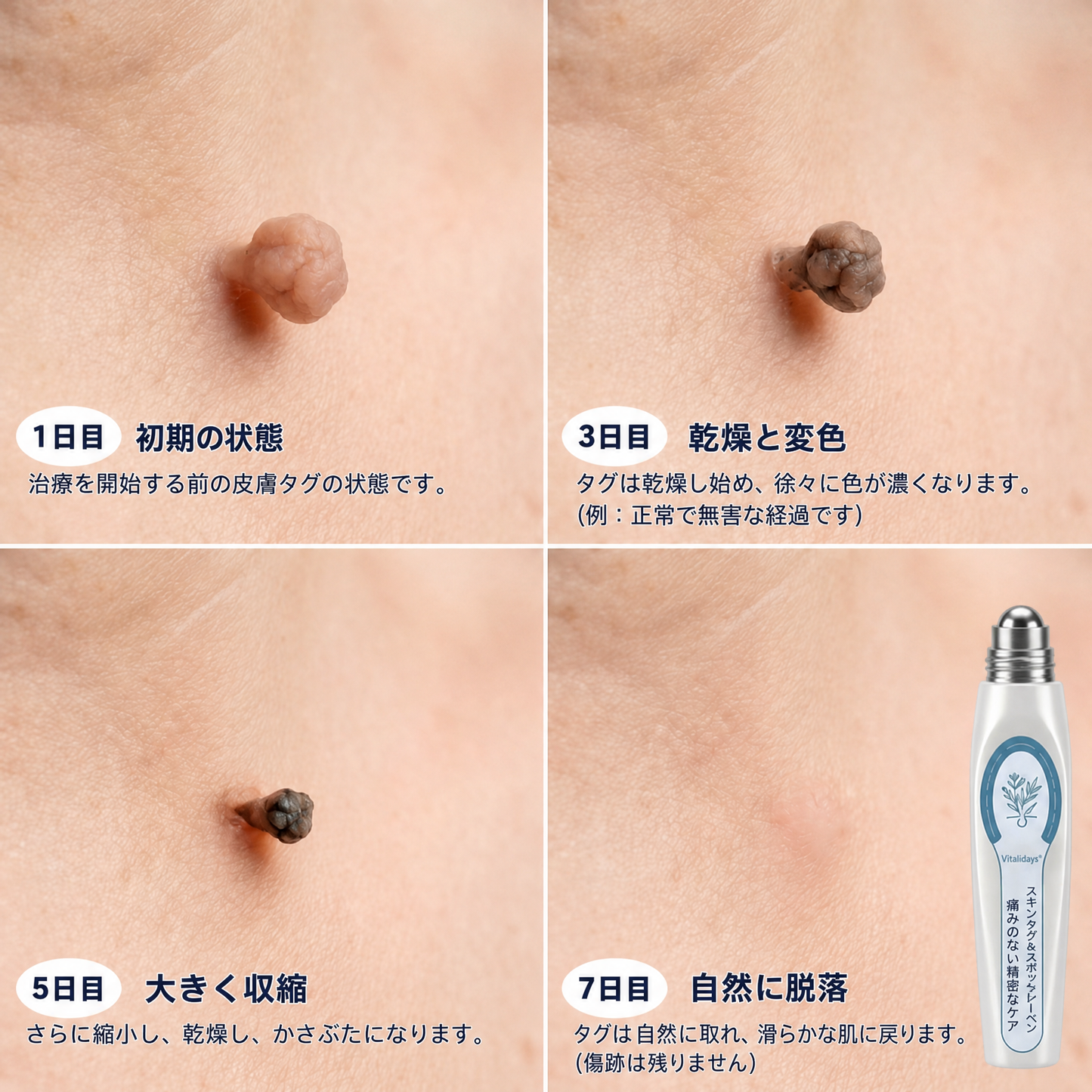 公式ブランドストア ✨|💕𝐕𝐢𝐭𝐚𝐥𝐢𝐬𝐲𝐬® 7日間 タグ＆スポットイレーサー（痛みゼロ・傷跡ゼロ ローラーボール）
