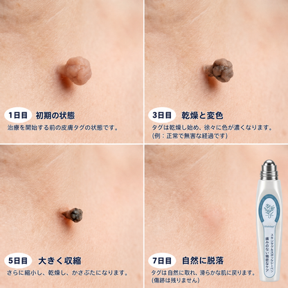 公式ブランドストア ✨|💕𝐕𝐢𝐭𝐚𝐥𝐢𝐬𝐲𝐬® 7日間 タグ＆スポットイレーサー（痛みゼロ・傷跡ゼロ ローラーボール）